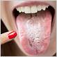 can mouth fungus cause gum disease