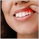 can my teeth be saved if i have gum disease