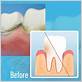 can oral irrigator reduce swollen gum under bridge