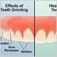can teeth grinding cause gum disease