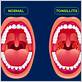 can tonsillitis cause gum disease