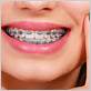 can u get braces with gum disease