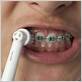 can u use a electric toothbrush with braces