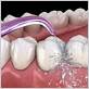 can waterpik damage receding gums