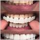 can you chew with dental veneers