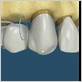 can you floss a dental bridge