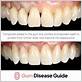 can you get composite bonding with gum disease