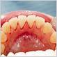 can you get dentures with gum disease