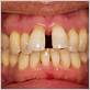 can you get false teeth if you have gum disease
