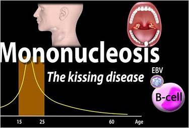 can you get gum disease by kissing