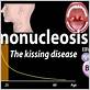 can you get gum disease by kissing