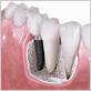 can you get implants if you have gum disease