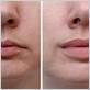 can you get lip fillers if you have gum disease