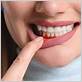 can you get permanent dentures with gum disease