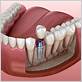 can you get tooth implants if you have gum disease