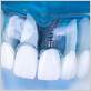 can you have dental implants with gum disease