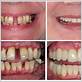 can you have false teeth after gum disease