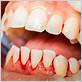 can you have gum disease without bleeding gums