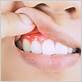 can you have gum disease without red painful gums