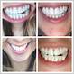 can you have invisalign with gum disease