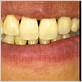 can you have veneers with gum disease uk