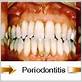 can you reverse periodontitis