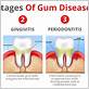 can you stop advanced gum disease