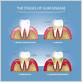 can you stop gum disease from progressing