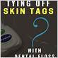 can you tie dental floss around skin tags