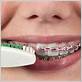 can you wear braces with gum disease