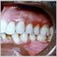 candida gums disease