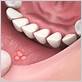canker sore or gum disease