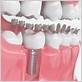 cant chew the same dental implant