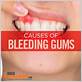 causes for bleeding gums