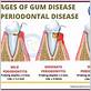 causes of pyria gum disease