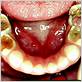 cavities gum disease