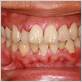 cavity gum disease
