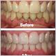 cbd gum disease before and after
