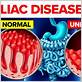 celiac disease and gum problems