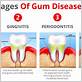 check for gum disease in elizabethton tn
