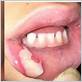 chewed lip after dental work