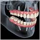 chewing after dental implant