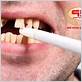 chewing tobacco after dental implant