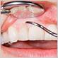 chicago heights gum disease treatments