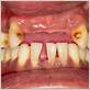 chin position in gum disease