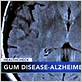 chronic gum disease alzheimer's