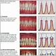 classification of gum disease