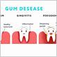 clindamycin for gum disease