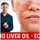 cod liver oil and gum disease