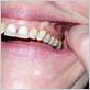 colloidal silver gum disease
